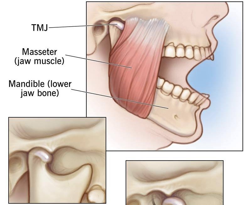 (TMJ) Disorders