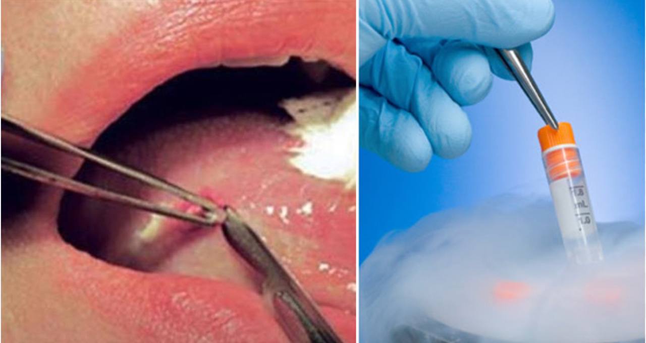 Oral biopsy