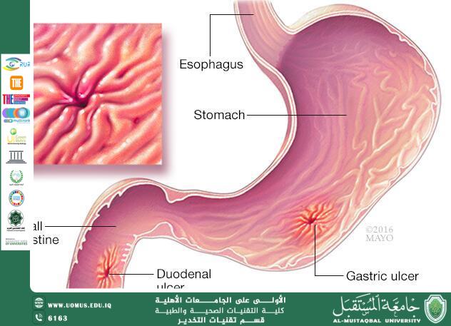 H pylori.docx