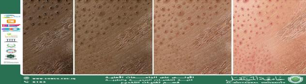 Dermatitis