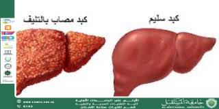 Fibrosis: causes, symptoms and treatment