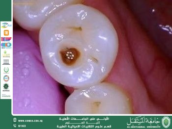 A scientific article by the lecturer (Asst. Lec.Amna shaker shahad ) titled"Tooth decay"