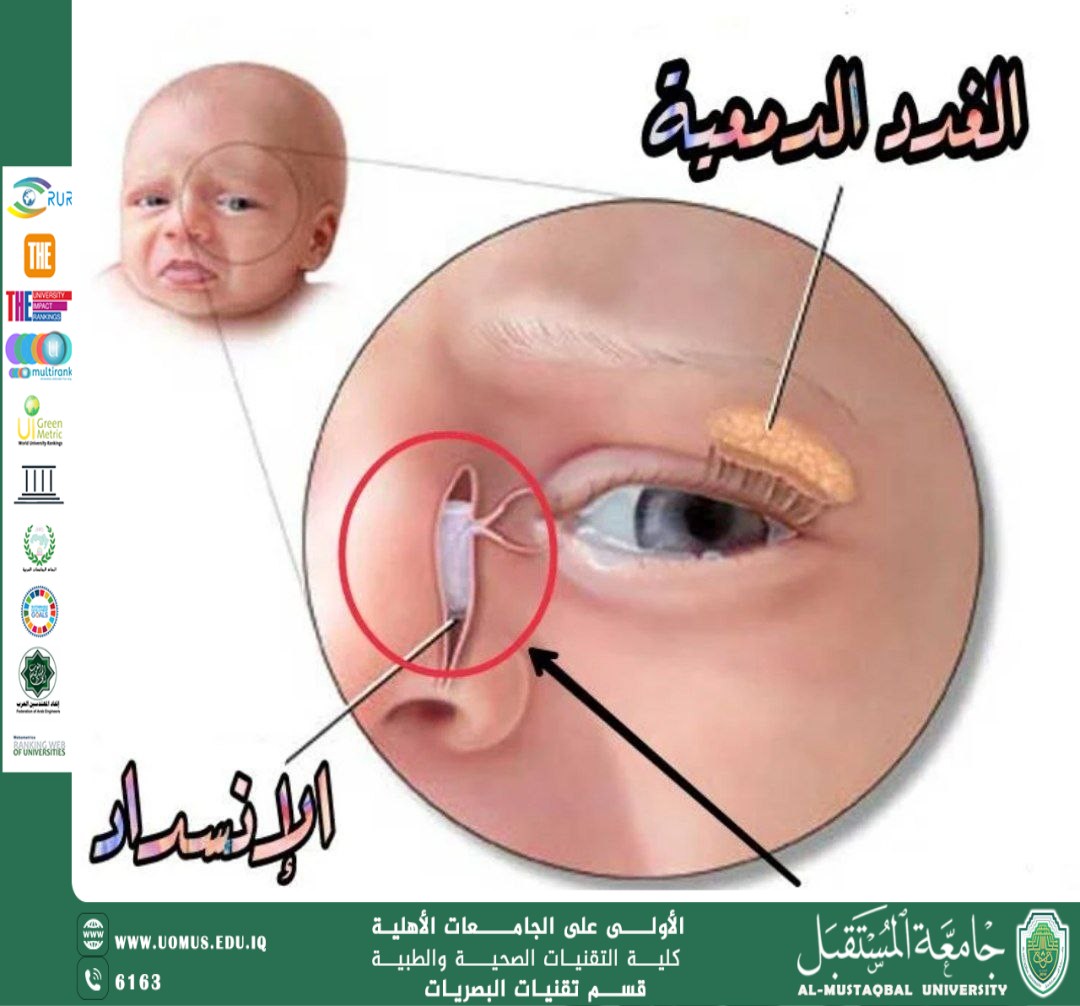 مقالة علمية للمعيدة زينب احمد عباس بعنوان(أضرار انسداد القناة الدمعية في العين)