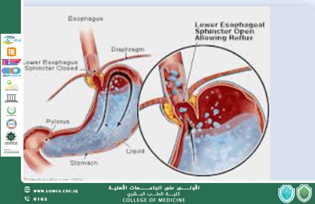 Gastroesophageal Reflux Disease (GERD) and Its Impact on the Upper Respiratory Tract