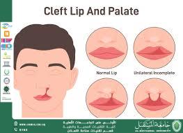 A cleft palate