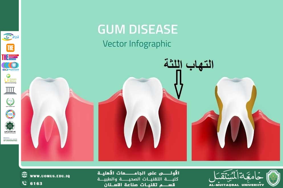 Gingivitis: its causes, symptoms, and methods of treatment and prevention