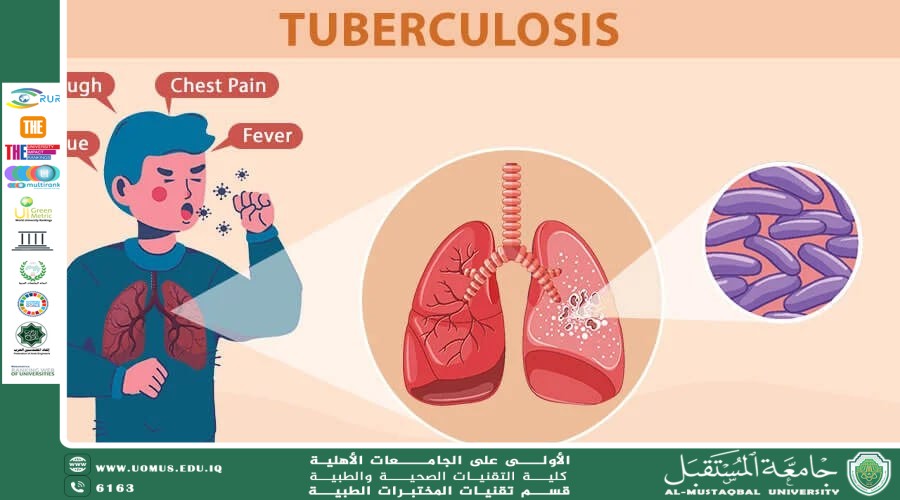 Tuberculosis مقالة علمية للدكتورة سجا لطيف بعنوان 