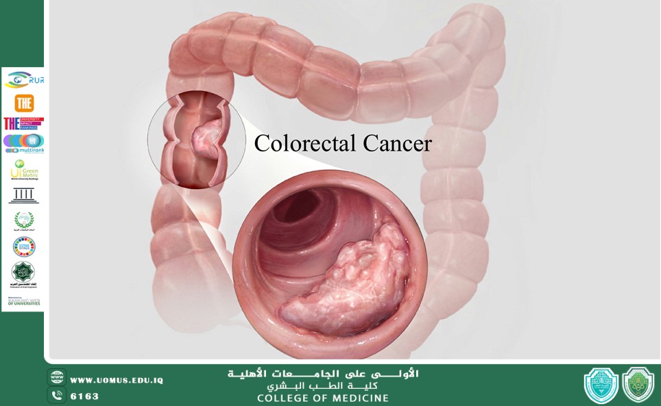 Colorectal cancer