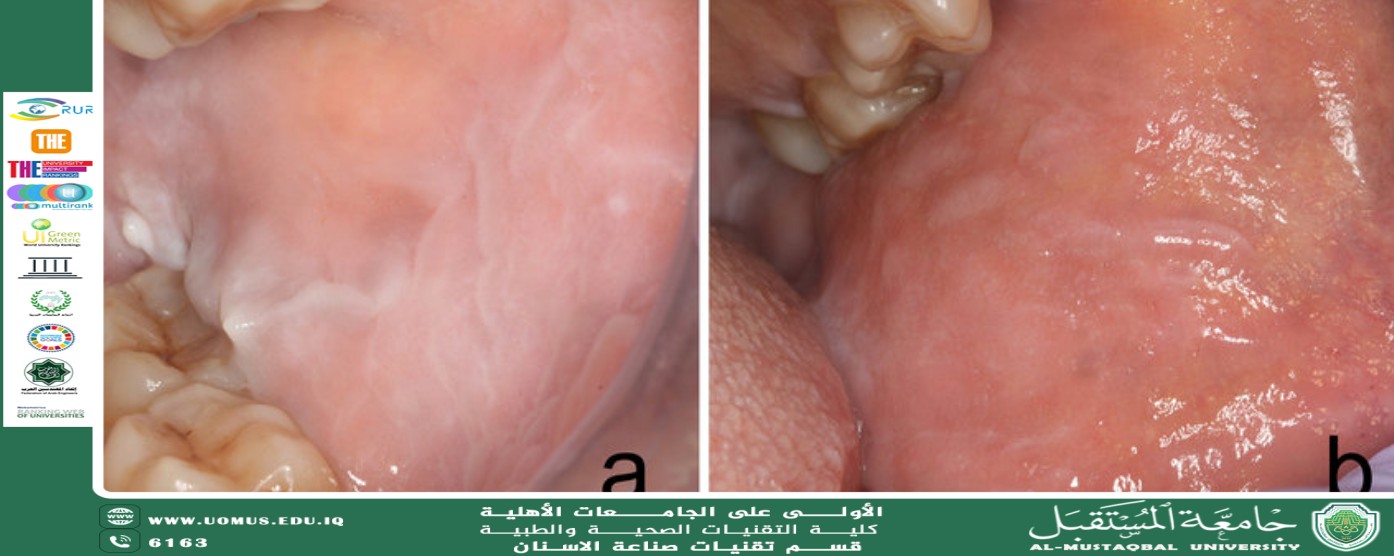 مقالة علمية بعنوان  Leukoedema