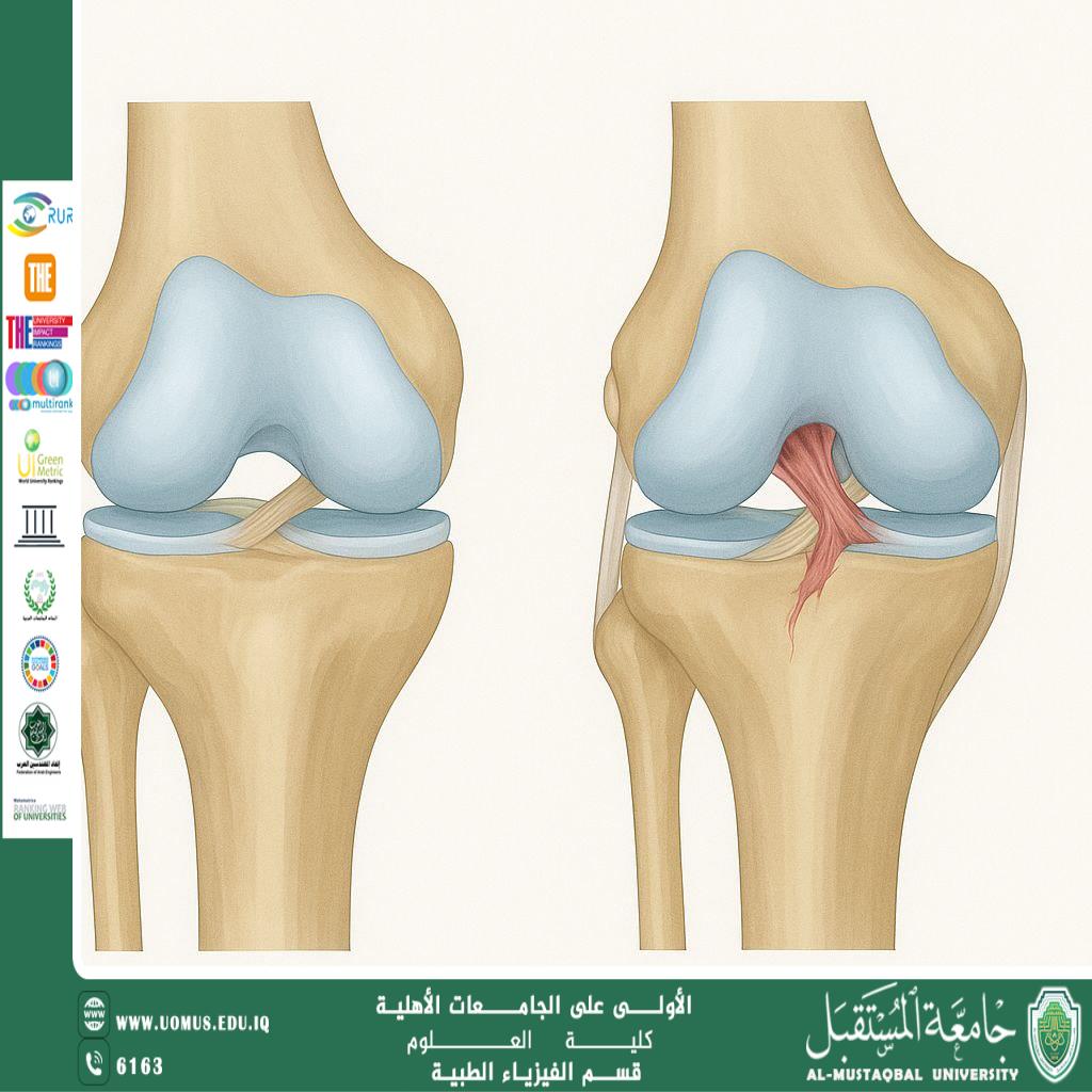 A scientific article by the teaching assistant (Hassan Hadi Saleh) entitled “Anterior Cruciate Ligament Rupture: Causes, Symptoms, and Treatment”