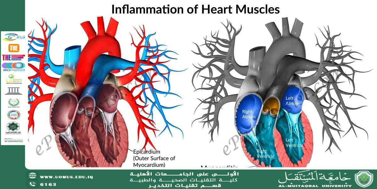 Myocarditis