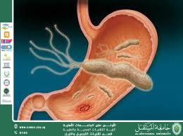 "Chronic Stomach Bacteria: The Silent Enemy in the Digestive System"
