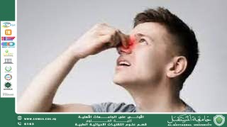 مقالة علمية (هبه صلاح هادي ) بعنوان " نزف الانف"