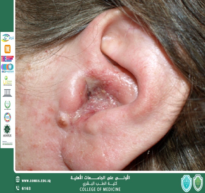 Chronic Otitis Externa: Causes and Advanced Treatments
