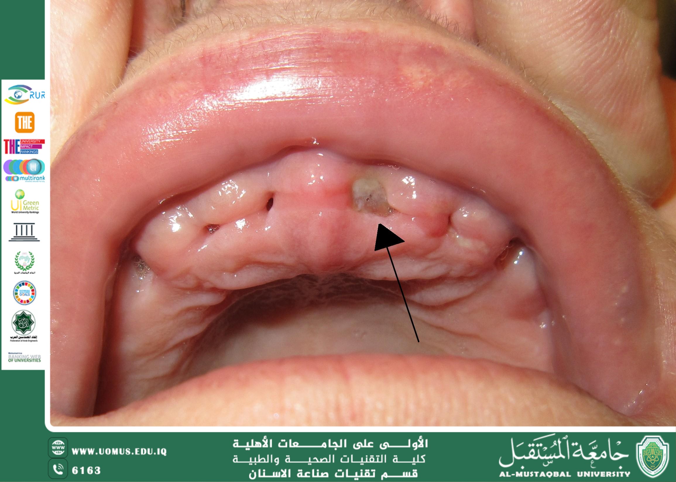 Alveolar Osteitis