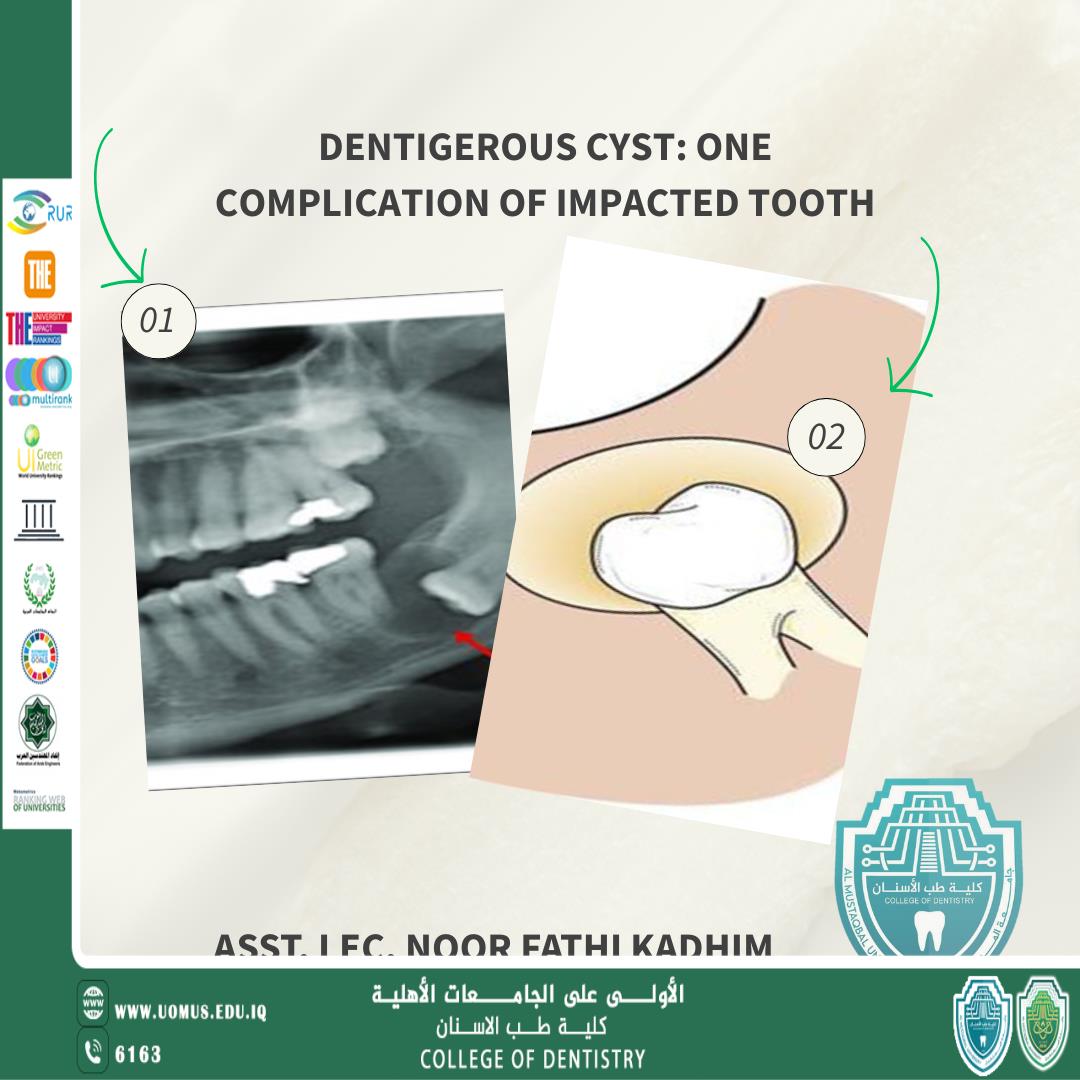 A new scientific article by Assistant Lecturer Noor Fathi Kadhim titled: **"Dentigerous Cyst: One Complication of an Impacted Tooth"