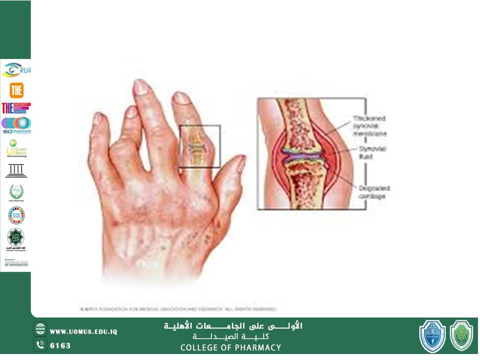 مقاله عن التهاب المفاصل الروماتويدي  بقلم الدكتور ميثم احمد عبد الائمه في كلية الصيدلة جامعة المستقبل