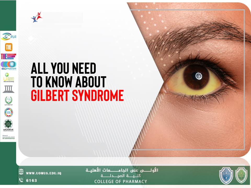 مقاله عن متلازمة كلبرت (Gilbert Syndrome)  بقلم ا.د.ندى خزعل في كلية الصيدلة جامعة المستقبل