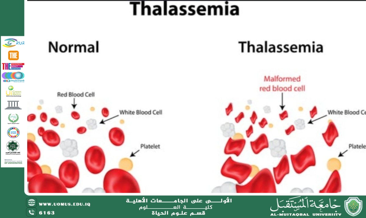 A scientific article by the teaching assistant, Ala Adel Rasmi, entitled "Thalassemia"