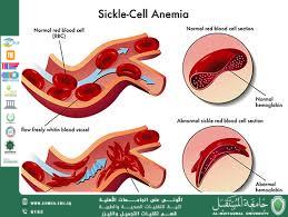 Scientific Article: Sickle Cell Anemia By: Ms. Huda Rafid Abdulkhaliq