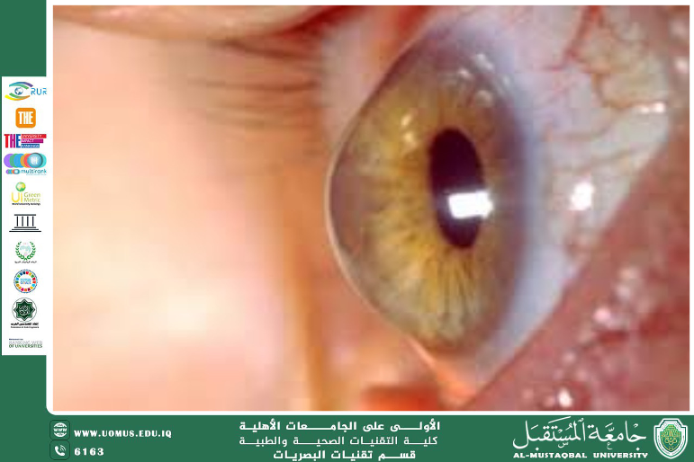  A scientific article by the lecturer, : Dr. Ghaith Ali Mahmoud (Keratoconus)