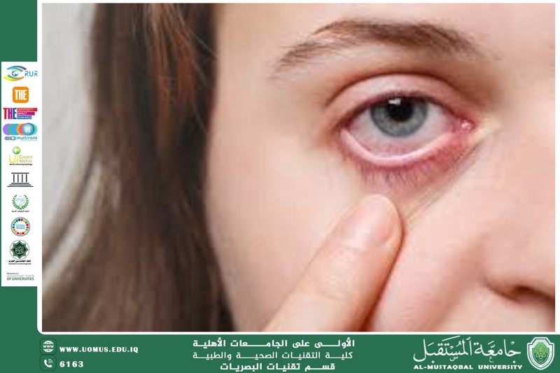  A scientific article by the lecturers, Assist.Prof.Dr. Munther Sameen Shukur / Lect. Mohaimen Sameer Aref / Lect. Ali Hadi Al-Husseini (Diabetic Retinopathy: Early Diagnosis and Treatment)
