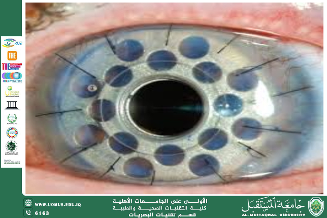  A scientific article by the lecturer, Lect. Ali Hadi Al-Husseini (Keratoprosthesis: Artificial Cornea Implantation)