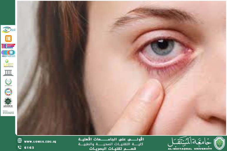  A scientific article by the lecturer, Lect. Ali Hadi Al-Husseini (Toxoplasmosis and Its Ocular Impact (Dry Eye Disease)