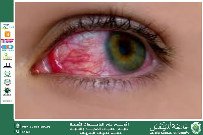  A scientific article by the lecturer, Asst. Lecturer Hassan Qahtan Kazem Al-Hussein (The Impact of Lymphadenitis on Ocular Health: A Comprehensive Clinical Perspective)