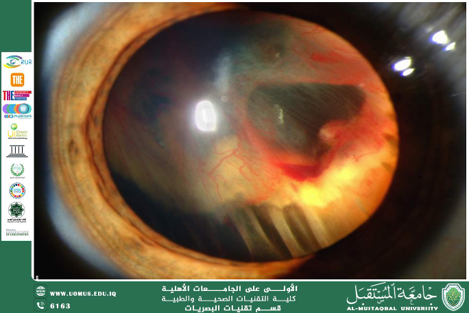  A scientific article by the lecturer,  Lect. Ali Hadi Al-Husseini (Retinal Detachment)