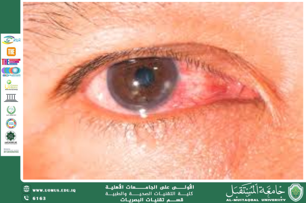  A scientific article by the lecturers, Assist.Prof.Dr. Munther Sameen Shukur / Asst. Lecturer. Mohaimen Sameer Aref / Asst. Lecturer. Ali Hadi Al-Husseini (Keratitis: Clinical Overview)