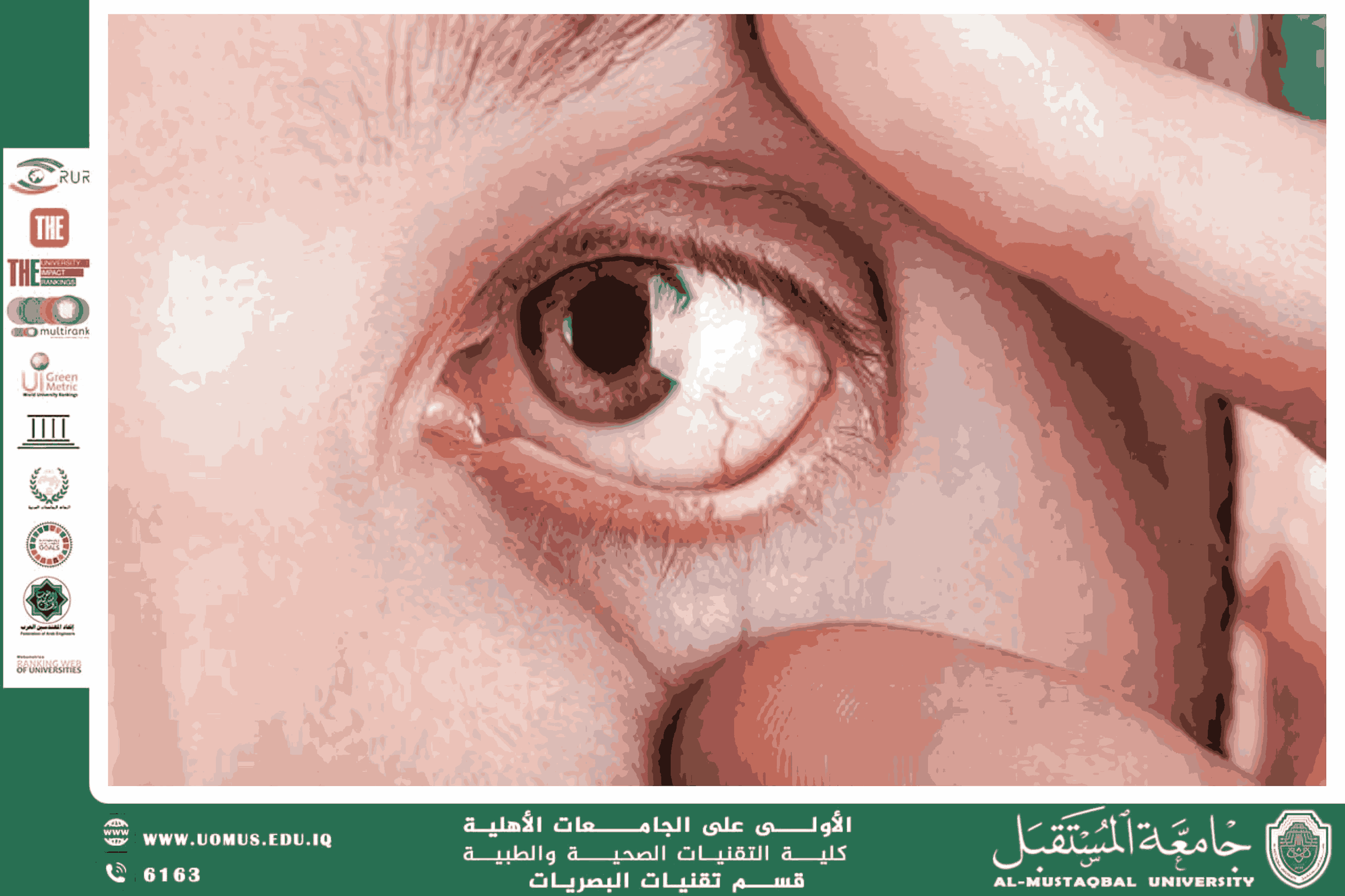  A scientific article by the lecturer, Assist.Lect. Ali Hadi Al-Husseini (Microscopic Corneal Alterations and Their Role in Systemic Disease Diagnosis)
