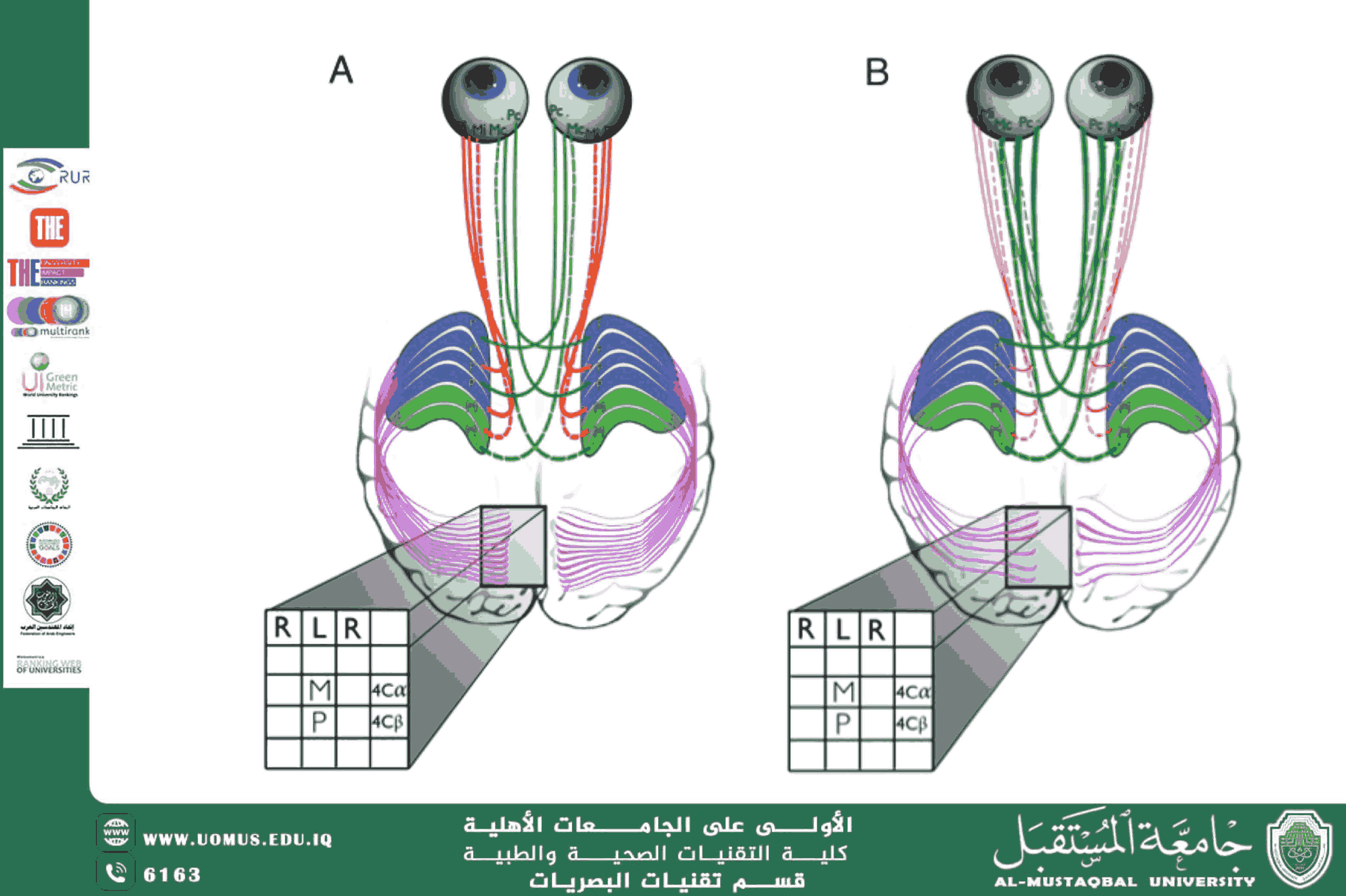  A scientific article by the lecturers, Assist.Lect. Mohaimen Sameer Aref (Neuroplasticity in Amblyopia and Strabismus: New Horizons in Visual Rehabilitation)
