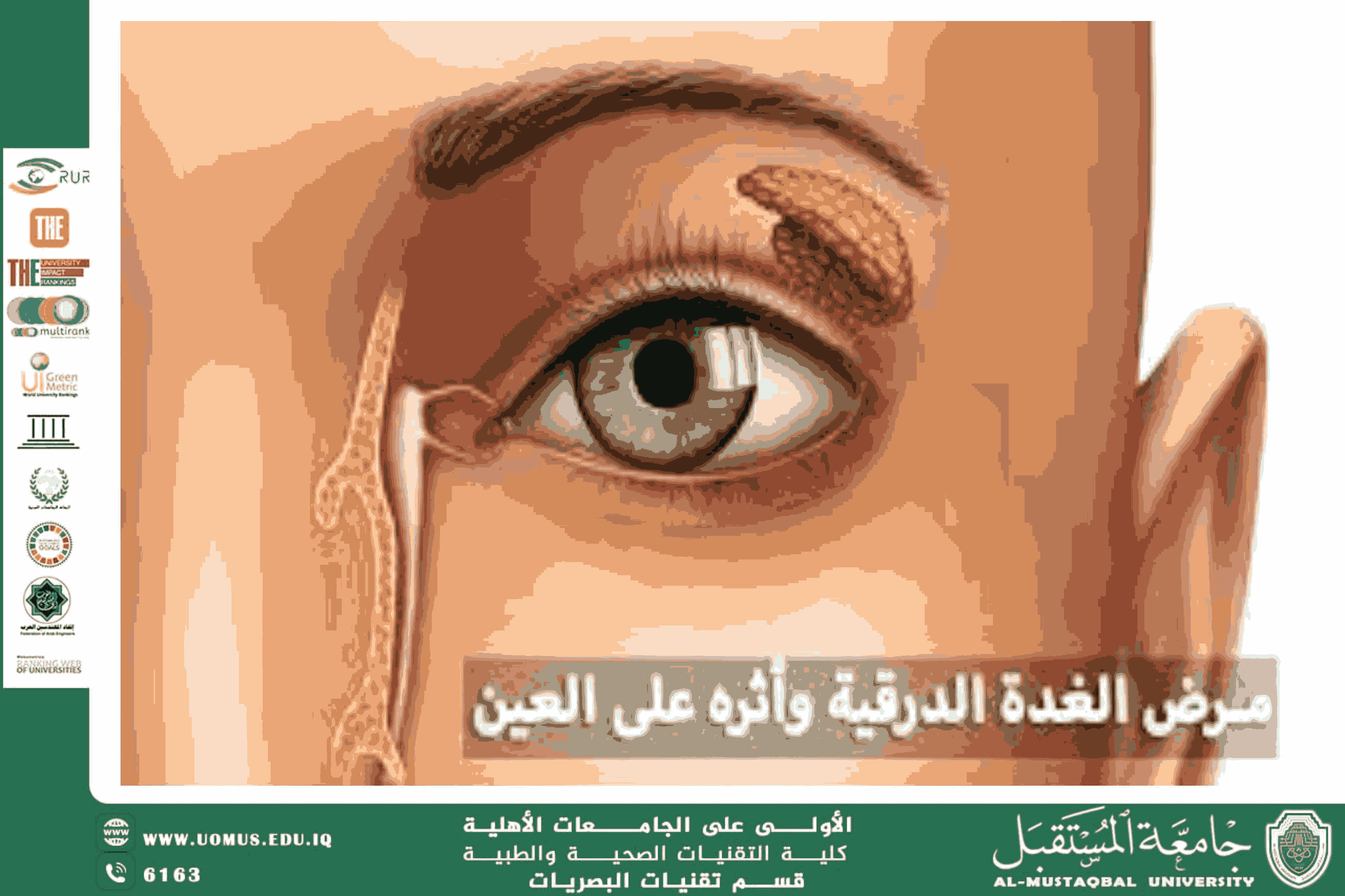  A scientific article by the lecturers, Assist.Lect. Mohaimen Sameer Aref (Thyroid Eye Disease: Clinical and Pathophysiological Insights)