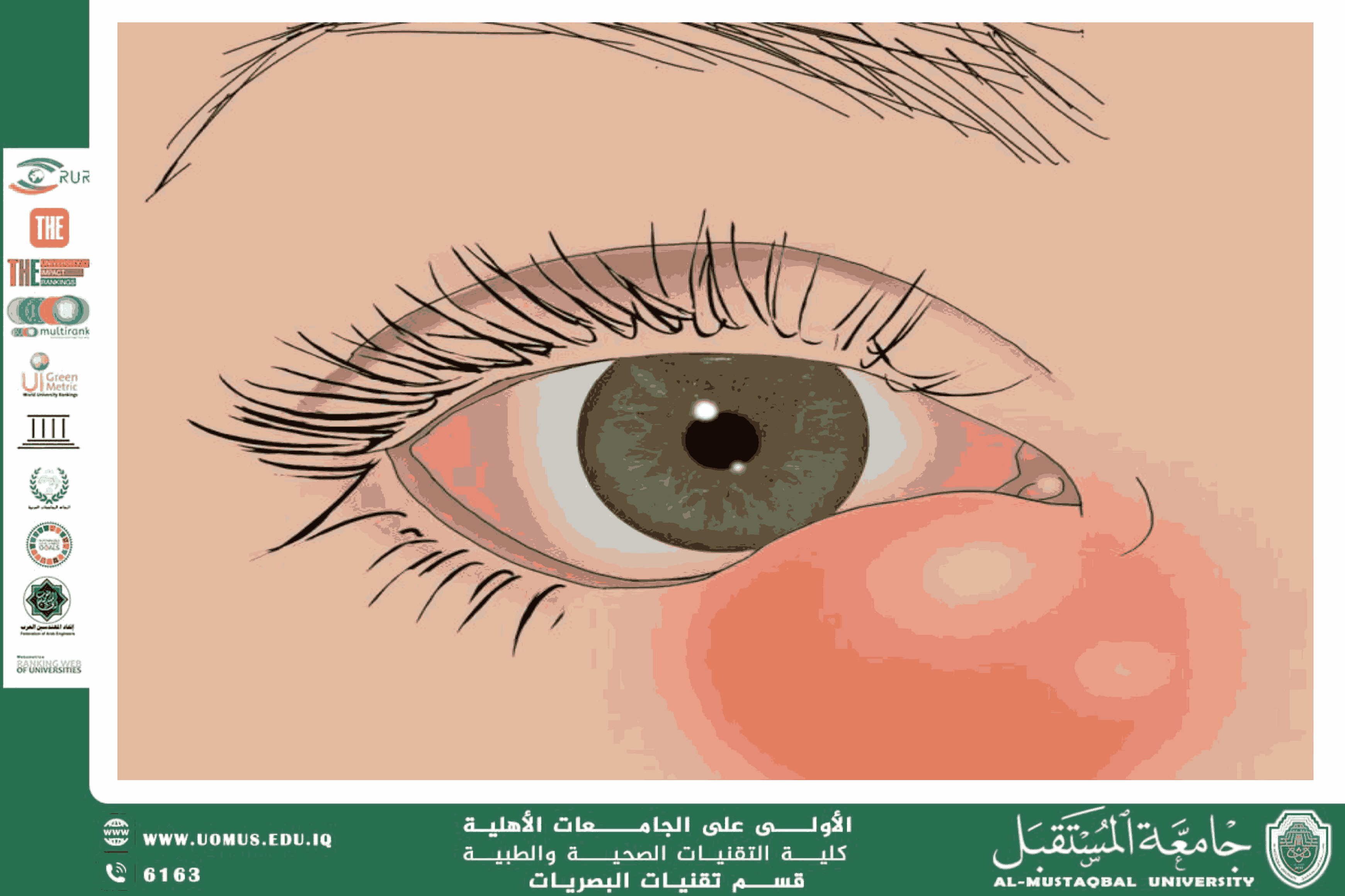  A scientific article by the lecturer, Assist.Lect. Ali Hadi Al-Husseini (Tear Fluid Analysis in the Early Diagnosis of Ocular Inflammatory and Immune Disorders)