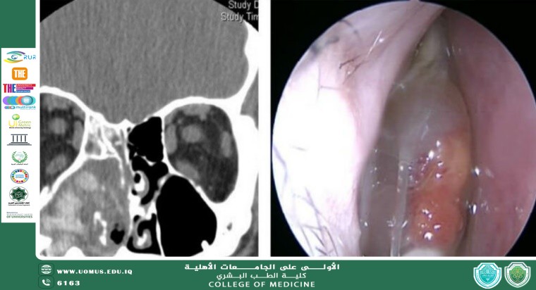 Challenges in Diagnosing and Treating Fungal Sinusitis