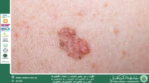 مقالة علمية للست شهد نورس عباس بعنوان دور قسم تقنيات التجميل والليزر في الوقاية من سرطان الجلد