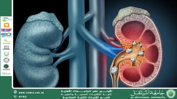 حصى الكلى: الأسباب، الأعراض، وطرق الوقاية