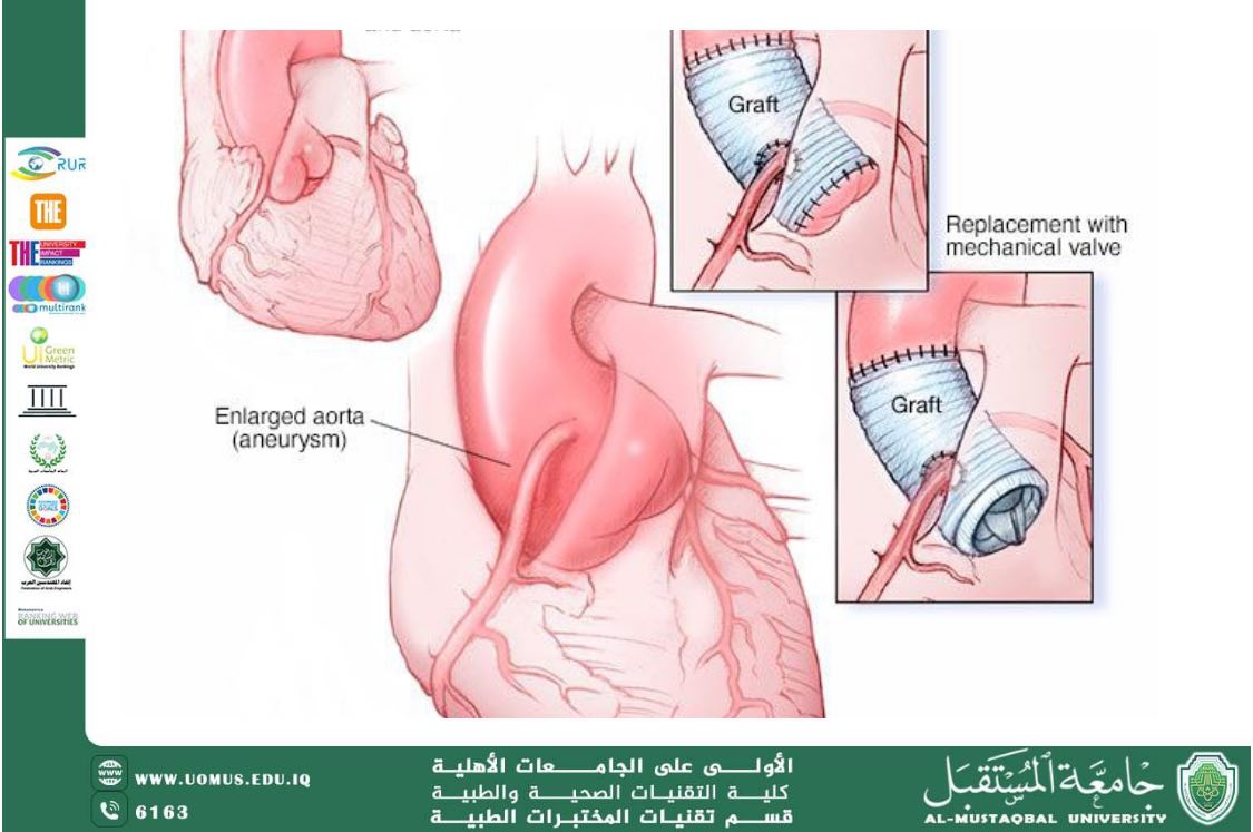 مقالة علمية للدكتورة ورود علي هذال بعنوان: “متلازمة مارفان: مرض وراثي نادر يصيب النسيج الضام وتأثيراته على أجهزة الجسم"