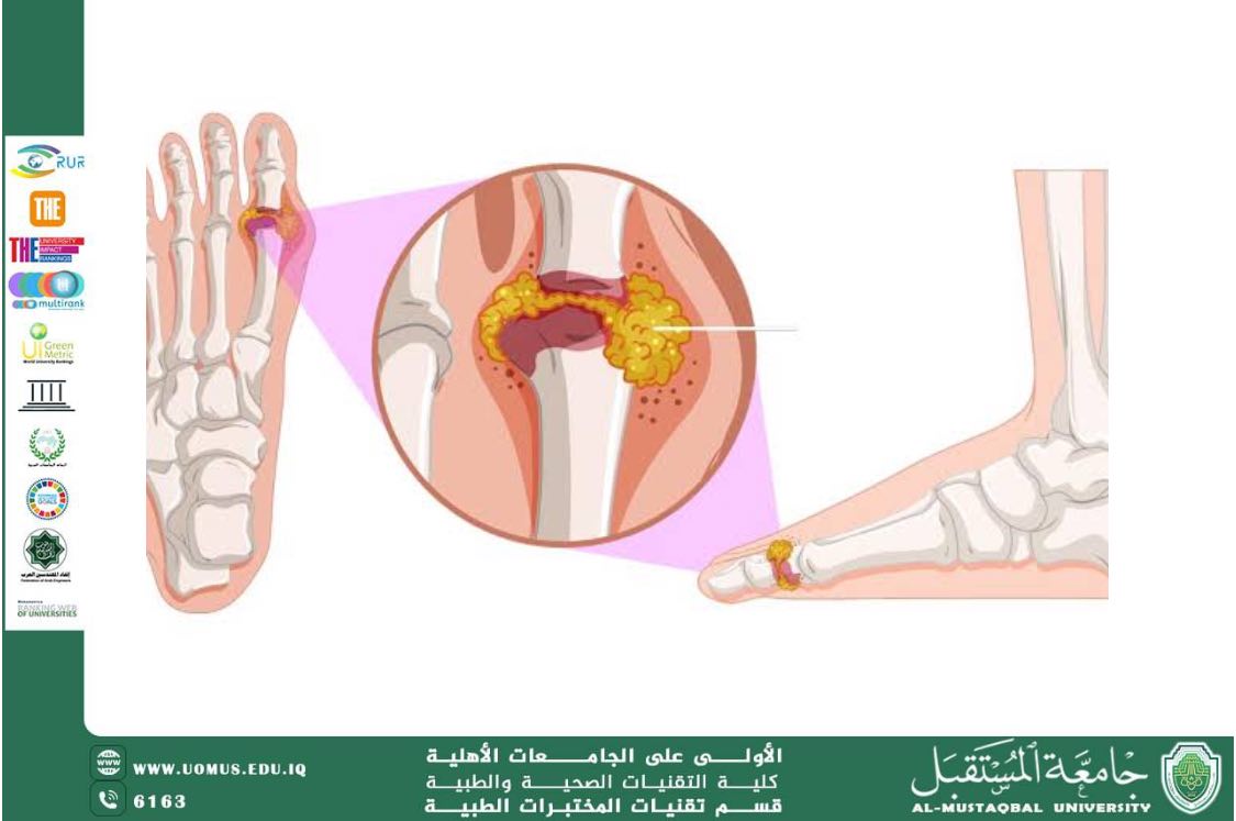 مقالة علمية للدكتور حازم يحيى سعيد بعنوان: مرض النقرس.