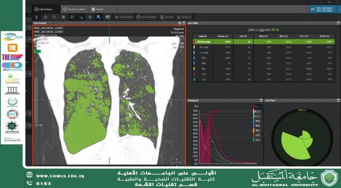 The Role of Artificial Intelligence in Diagnosing Lung Diseases on CT Scans