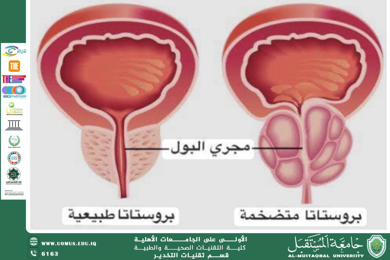 مقالة علمية للدكتور احمد خضير عن تضخم البروستات عند الرجال (Benign Prostatic Hyperplasia - BPH)